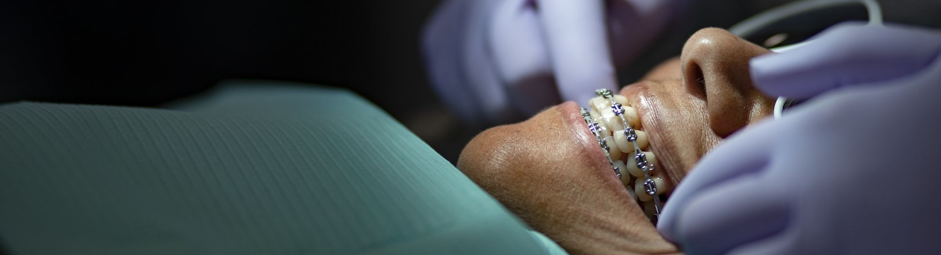 An orthodontics patient with braces being treated by a dentist wearing purple latex gloves.