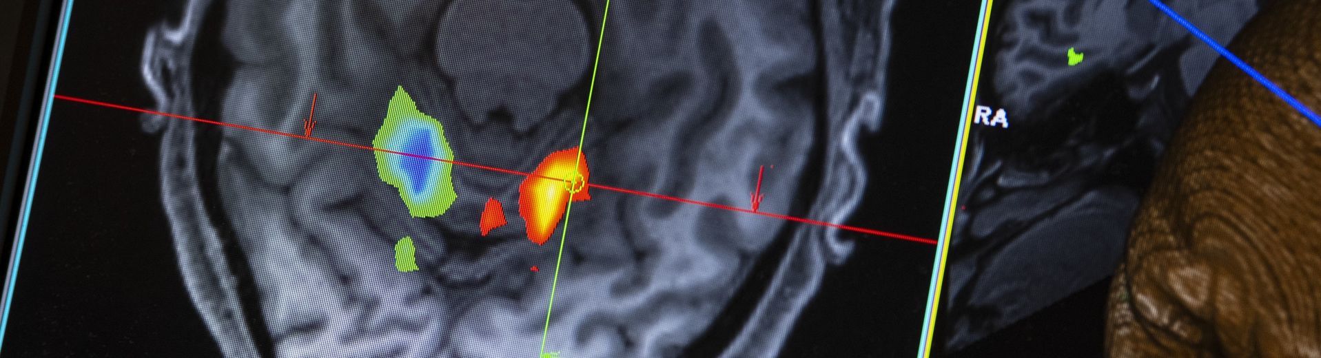 A computer screen show's an image of a patient's brain.